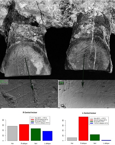 <span>OH‐65 pokazuje koncentrację wyżłobień na wargowych stronach przednich zębów. Widać je gołym okiem.  W badaniu mikroskopowym dopasowują się do wyżłobień znajdowanych u znacznie późniejszych hominidów. Wyżłobienia głównie ograniczają się do lewego i prawego I1, prawego I2 i prawego C1. Dominują prawoskośne zadrapania, prowadząc do identyfikacji OH‐65 jako osobnika praworęcznego. (n = liczba wyżłobień dla kategorii)</span>