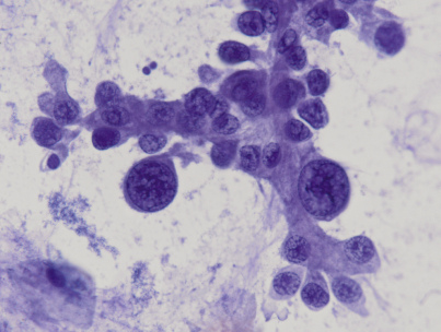 <span>Brodawkowata odmiana raka gruczołowego płuc; F D’Aleo, M Maisano i G Albonico; </span>https://www.flickr.com/photos/pulmonary_pathology/6327961776/<span>, CC BY-SA 2.0</span>
