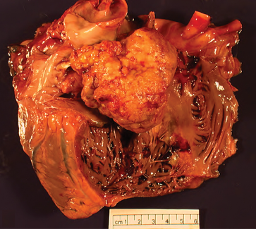 <span>Przerzut raka płuca w sercu; </span>http://www.archivesofpathology.org/doi/full/10.5858/arpa.2011-0521-OA?code=coap-site