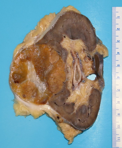 Onkocytoma nerki, guz łagodny, choć czasem groźnie wyglądający; Emmanuelm; CC BY 3.0