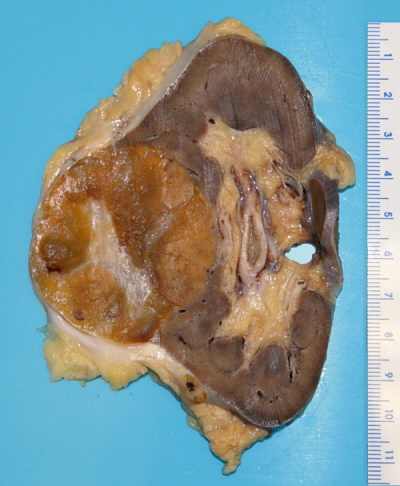 Onkocytoma nerki, guz agodny, cho czasem gronie wygldajcy; Emmanuelm; CC BY 3.0