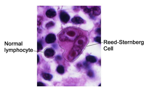 Komórka Reed-Sternberga w otoczeniu prawidowych limfocytów; NIH, domena publiczna