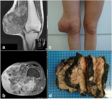 Misak synowialny okolicy kolana trzydziestoletniej kobiety, po lewej obrazy z MRI; CC BY 4.0, https://www.ncbi.nlm.nih.gov/pmc/articles/PMC4412097/