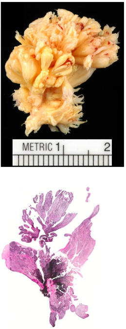 Fibroelastoma papillare, na obrazie mikroskopowym widoczne wybarwione na czarno wókna elastyczne; CC BY; http://www.ncbi.nlm.nih.gov/pmc/articles/PMC3745854/