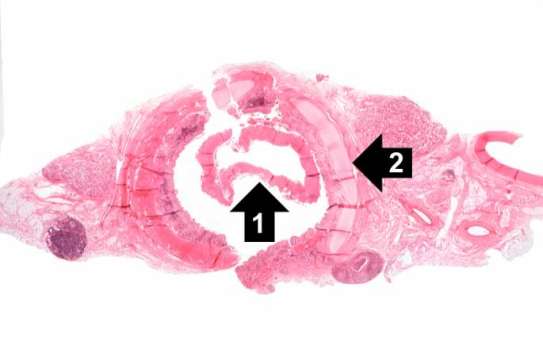 Przekrój przez tchawic czterolatki zmarej w przebiegu bonicy; pierwsza ze strzaek pokazuje zuszczajc si martwiczo-wóknikow bon, druga – chrzstk tchawicz; Pathology Education Instructional Resource (PEIR), University of Alabama at Birmingham Department of Pathology; http://peir.path.uab.edu/wiki/IPLab:Lab_9:Diphtheria