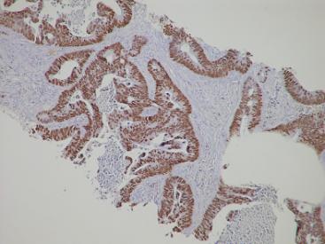 <span>Przerzut raka gruczoowego jelita grubego w pucu; brzowe paki to jdra komórkowe wybarwione przeciwciaem przeciwko CDX2; Yale Rosen, </span>https://www.flickr.com/photos/pulmonary_pathology/5477029587/