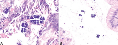 Pakiety Sarcina ventriculi; z prawej strony wida fragment nabonka gruczoowego odka; http://www.archivesofpathology.org/doi/pdf/10.5858/arpa.2016-0028-RS