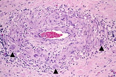 Komórki olbrzymie w cianie ttnicy krezkowej; http://www.ncbi.nlm.nih.gov/pmc/articles/PMC1824723/