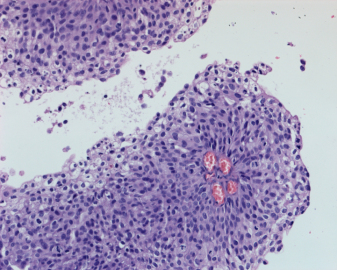 <span>Jedna z brodawek ksztatujcych powierzchni raka pcherza (w redku dorobne naczynia krwiononie); CC BY-NC 4.0, </span>https://www.ncbi.nlm.nih.gov/pmc/articles/PMC6218121/