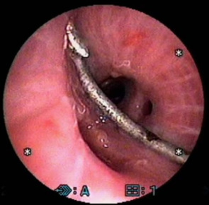 Haczyk w wietle prawego oskrzela; https://www.ncbi.nlm.nih.gov/pubmed/23207367