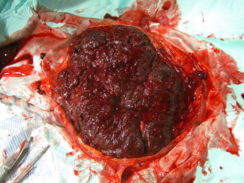 Zwyke oysko (popód) od strony matczynej; CC BY-SA 3.0; https://en.wikipedia.org/wiki/File:Human_placenta_01.JPG