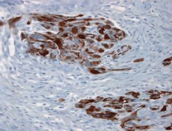 Misak nabonkopodobny przypomina raki take immunohistochemicznie – na brzowo wyznakowano cytokeratyny typowe dla tkanek nabonkowych; https://www.humpath.com/spip.php?article3077