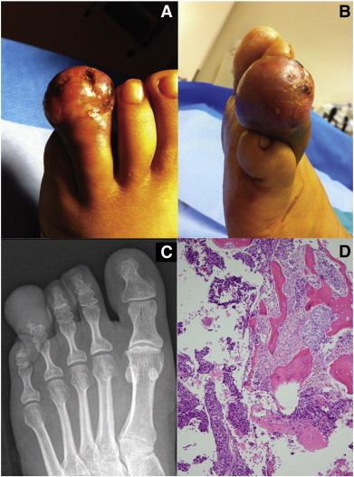 Przerzut raka szyjki do palca stopy – dolne zdjcie po prawej pokazuje zajcie koci; CC-BY-ND, https://www.ncbi.nlm.nih.gov/pmc/articles/PMC3930812/