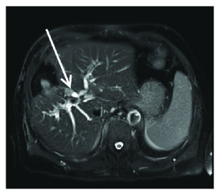 <span>MRI pokazuje zmian w wietle przewodów óciowych; </span>https://www.ncbi.nlm.nih.gov/pmc/articles/PMC4939185/