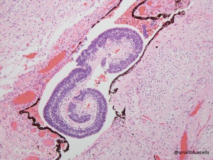 W tym potworniaku jajnika poród pól tkanki nerwowej formuje si nieco ciemniejsza, limaczo podwinita siatkówka oka; Jason Jarzembowski‏, https://twitter.com/smallbluecells/status/863111778678558720