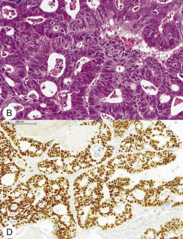 <span>Przerzut raka jelita grubego w uchwie, na dole odczyn immunohistochemiczny przeciwko CDX2; </span>https://scielo.conicyt.cl/pdf/ijodontos/v9n2/art19.pdf