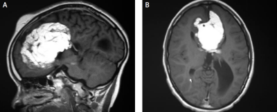 Duy (do 10cm) uszczak ródmózgowy u dziesiciolatka – biaawy obszar w badaniu MRI – zwizany z wodogowiem; CC BY-NC-SA 4.0, http://www.termedia.pl/Giant-intracranial-lipoma,20,9581,1,1.html