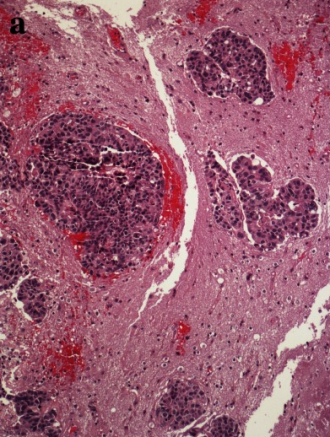 <span>Wyspy raka gruczołowego płuc pośród jasnoróżowej tkanki mózgowej i wylewów krwi; CC BY 4.0, </span>https://www.ncbi.nlm.nih.gov/pmc/articles/PMC4821869/