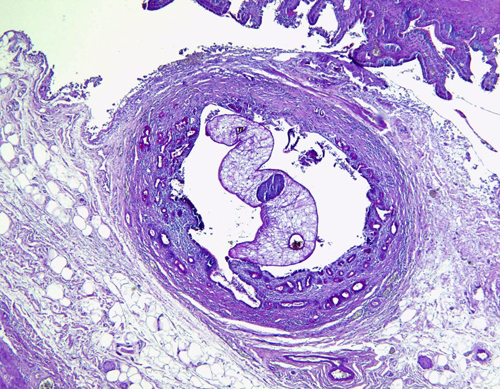 Dorosa przywra z rodzaju Opisthorchis wewntrz przewodu óciowego; ©2015 by the ASTMH; dozwolony uytek niekomercyjny; http://www.ncbi.nlm.nih.gov/pmc/articles/PMC2946733/