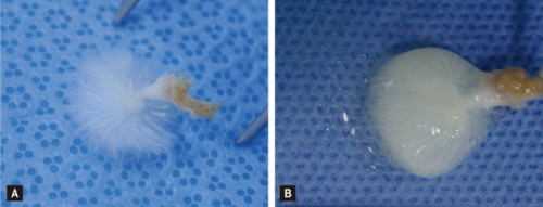 Fibroelastoma papillare, na zdjciu po lewej stronie zanurzony w wodzie, by lepiej uwidoczni pierzast struktur; CC BY-NC 3.0; http://www.ncbi.nlm.nih.gov/pmc/articles/PMC3543966/