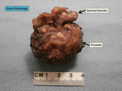 <span><span>Prostata z pcherzykami nasiennymi; Jian-Hua Qiao; </span>https://www.flickr.com/photos/jian-hua_qiao_md/8519225312</span>
