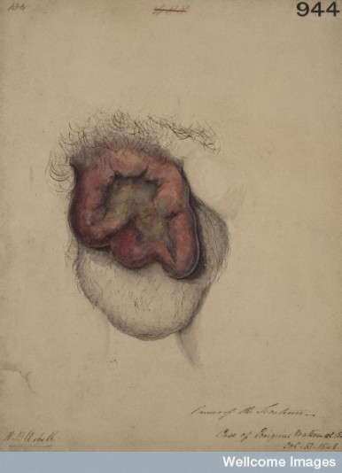 Horace Benge Dobell, dziewitnastowieczna akwarela przedstawiajca raka moszny, CC BY 4.0, https://wellcomeimages.org/indexplus/image/L0062113.html