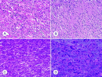 To wszystko nadal róne formy histologiczne tego samego nowotworu; http://www.ncbi.nlm.nih.gov/pubmed/17090188
