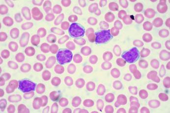 Przewleka biaaczka limfocytowa – limfocyty, które nie chc umrze; Ed Uthman, https://www.flickr.com/photos/euthman/2869815349/, CC BY 2.0