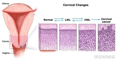 Naturalny przebieg zmian prowadzcych do raka szyjki macicy; NIH, National Cancer Institute; http://www.cancer.gov/types/cervical/understanding-cervical-changes