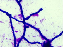 …lepiej powiodo si ekipie badajcej wymaz z owrzodzenia; CC BY-NC-ND 4.0, https://www.ncbi.nlm.nih.gov/pmc/articles/PMC4398817/