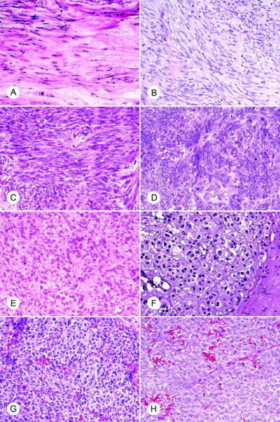 GISTy potrafi wyglda nader rónorodnie i bez dodatkowych bada trudno jest je jednoznacznie zdiagnozowa; http://www.ncbi.nlm.nih.gov/pubmed/17090188