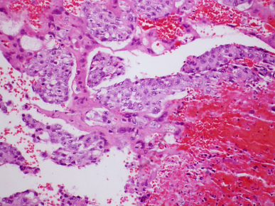 <span>Przerzut choriocarcinoma do puc; Yale Rosen, CC BY-SA 2.0, </span>https://www.flickr.com/photos/pulmonary_pathology/5433741268/