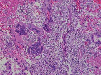 <span>Wielojdrzaste “pezaki” syncytiotrofoblastu w kosmówczaku zoliwym jdra; </span>https://www.cambridge.org/core/books/silverbergs-principles-and-practice-of-surgical-pathology-and-cytopathology/testis-paratesticular-structures-and-male-external-genitalia/226B23C579CD18686AEFA2E4847F5B07