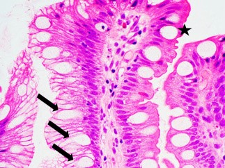 <span>Komórki kubkowe (gwiazdka) w przeyku Barretta – obraz peen puapek, bo np. komórki oznaczone strzakami tylko kubkowe udaj, co moe niekiedy zmyli diagnozujcych; </span>https://www.ncbi.nlm.nih.gov/pmc/articles/PMC4833583/