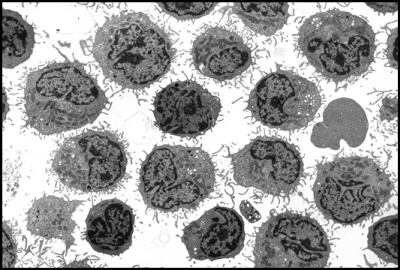 Biaaczka wochatokomórkowa; University of South Alabama, http://pathresidents.com/usapathology/em-handbook/tumor-recogn-section/tumor-pages/mycosis-fungoides.html