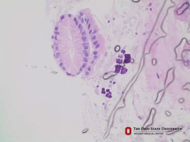 I znów znajome pakieciki; http://pathology.osu.edu/ext/COTW/cases/1-50/case30.aspx