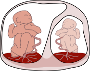 Schematyczne przedstawienie blinit z TTTS – mae anemiczne versus due rumiane; Kevin Dufendach, CC BY 3.0