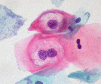 Komórki nabonka paskiego zakaonego HPV (koilocyty) z typowym przejanieniem wokó jdra w cytologii ginekologicznej; E. Uthman; CC-BY-SA 2.0, https://www.flickr.com/photos/euthman/384102992