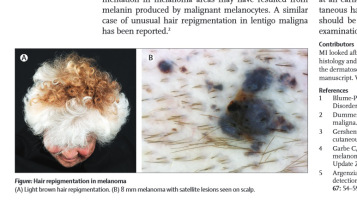 Pacjentka z czerniakiem owosionej skóry gowy; http://www.sciencedirect.com/science/article/pii/S0140673613616049#