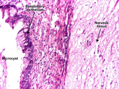 Obraz mikroskopowy potworniaka jajnika – po lewej nabonek oddechowy, po prawej tkanka nerwowa; Dr Mihai Danciu, http://www.pathologyatlas.ro