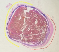 Wypeniony kaow treci uchyek wysany zwyk (granatowa warstewka) bon luzow jelita grubego, czciowo zawierajcy w cianie teke warstw miniow ciany jelita; https://www.ncbi.nlm.nih.gov/pmc/articles/PMC4195049/