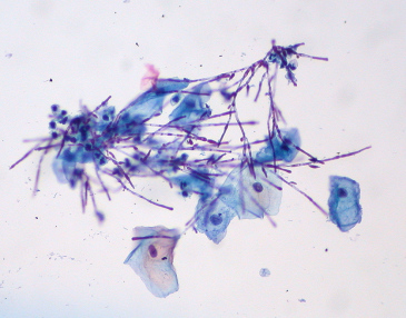 Naprawd wiemy, jak wyglda Candida pod mikroskopem i nie, nie wyglda ani jak rak, ani jak jakikolwiek inny nowotwór zoliwy; tu akurat pseudostrzpni grzyba w cytologii ginekologicznej; Ed Uthman, https://www.flickr.com/photos/euthman/3952574619