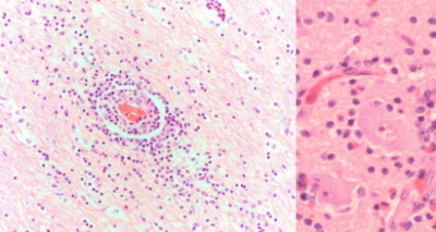 Obraz mikroskopowy mózgu Knuta; widoczny naciek zapalny (ciemniejsze fioletowe kropki) i niezmienione komórki nerwowe – ciemniejsze róowe plamy na powikszeniu po prawej; CC BY 4.0; http://www.nature.com/articles/srep12805