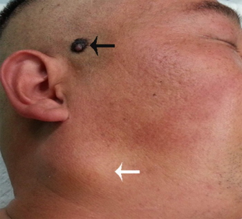 Czerniak skóry owłosionej głowy z przerzutem w śliniance; CC BY-NC 3.0; http://www.ncbi.nlm.nih.gov/pmc/articles/PMC4348854/