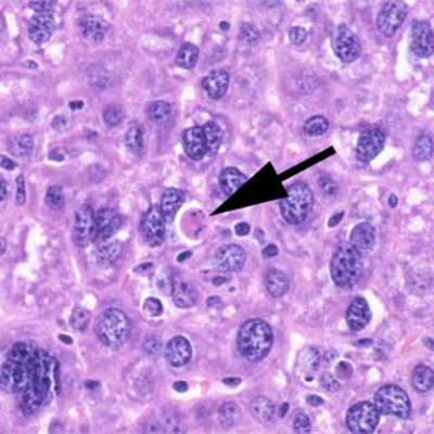 Spokojnie i bez odczynu zapalnego umierajca na drodze apoptozy komórka wtroby; domena publiczna, NIH, https://pl.wikipedia.org/wiki/Plik:Apoptosis_mouseliver.jpg