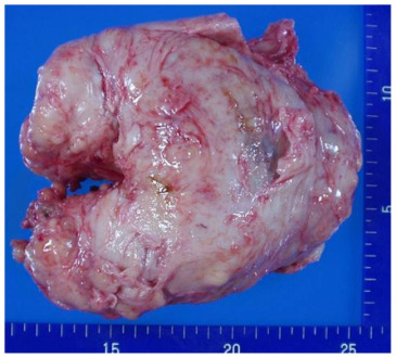 A to ju gruczo zdecydowanie zbyt duy – 475 g, 13 cm w najwikszym rozmiarze; CC BY, https://www.ncbi.nlm.nih.gov/pmc/articles/PMC3526873/