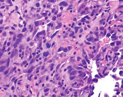 Angiosarcoma. Intensywnie dzielce si (gwiazdkowata mitoza porodku i nieco po lewej) pulchniutkie komórki ródbonka, a pomidzy nimi ucinite wskie przestrzenie naczyniowe z nielicznymi czerwonymi krwinkami; https://escholarship.org/uc/item/0053z21b