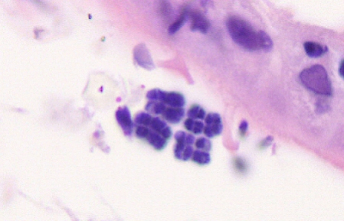 I jeszcze raz z bardzo bliska; http://pathology.jhu.edu/gicases/case.cfm?case=70