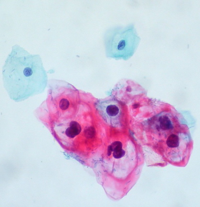 Grupka koilocytów z wyranymi przejanieniami okoojdrowymi, nad nimi dwie zwyke komórki nabonkowe o mniejszych, janiejszych jdrach; Ed Uthman; CC BY-SA 2.0
