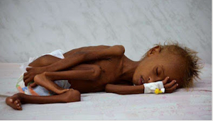 Jedna z porednich ofiar wojny w Jemenie.  Raport UNICEF z 2016 r. stwierdza, e „jedno dziecko umiera co 10 minut z powodu niedoywienia, biegunki i infekcji dróg oddechowych”.